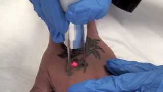 QSwitched NdYAG Tattoo Removal Laser  The Astanza Duality [upl. by Sherr150]