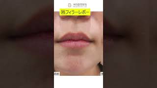 【皮膚科体験】ぷにゅぷにゅでボリューム感のある唇に💋┃ブラウン皮膚科┃美容 整形ビフォーアフター 韓国整形 韓国 ビフォーアフター スキンケア 唇 ヒアルロン酸 ヒアルロン酸注射 [upl. by Gewirtz]