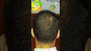 PRP Hair Loss Treatment Before and After  PRP Results [upl. by Cl]