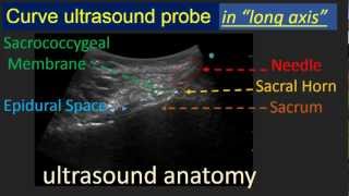 Ultrasound Guided Caudal Epidural Blockmpg [upl. by Wilona]