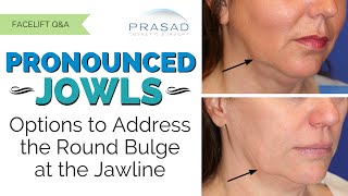 The Different Causes of Jowls Along the Jawline and their Customized Treatments [upl. by Raasch]