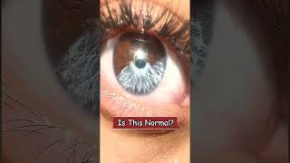 Girl Has Rare Eye Called Heterochromia [upl. by Akeihsat412]