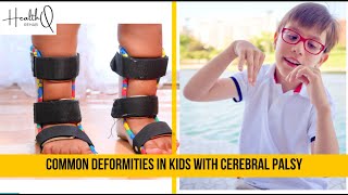 Common deformities among cerebral palsy kids [upl. by Einot]