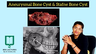 Aneurysmal Bone Cyst  Stafne Bone Cyst  Lecture 18  Oral Pathology [upl. by Llednek]