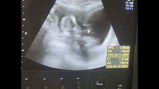 Bicornuate uterus 14wks pregnancy Diagnostic ultrasound cases [upl. by Nielson619]