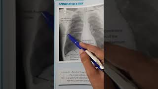 How to Interpret a Chest XRay Lesson 4  Airways Bones and Soft Tissues [upl. by Kenward796]