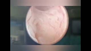 Endo Cervical Polyp Remove By Hysteroscopy [upl. by Enitsud839]