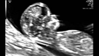 Ultrasound Video Part One 12 Weeks amp 2 Days Its a girl 101512 [upl. by Nele]