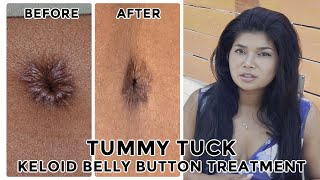 Tummy Tuck can result in keloid belly button How to treat amp before and after pictures [upl. by Hansiain585]