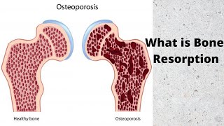 What is Bone Resorption [upl. by Hawkins]