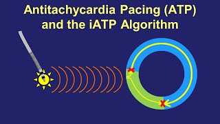 Antitachycardia Pacing ATP  How it Works How to Improve [upl. by Nosilla]