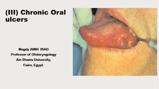 III Chronic Oral Ulcers [upl. by Gnivre]