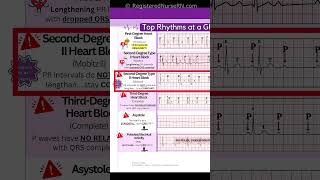 ECG EKG Rhythms to Know Sinus Rhythms Sinus Tachycardia Heart blocks etc [upl. by Oremodlab]