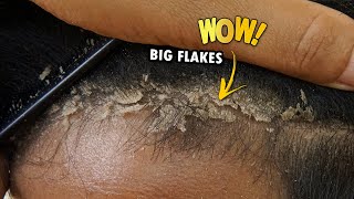 Removing Psoriasis Flaky Scalp Satisfying 373 [upl. by Hamo509]