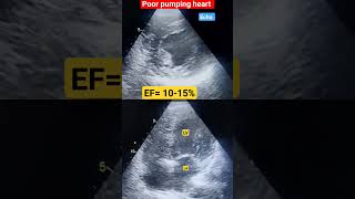 Poor pumping heart l EF 1015 echo shorts [upl. by Gone]