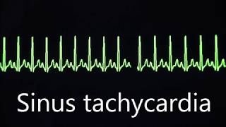 Cardiovascular System 8 Normal and abnormal heart rhythms [upl. by Dobrinsky]