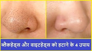 BLACKHEADS AND WHITEHEADS को हटाने के 4 उपाय  REMOVE BLACKHEADS AND WHITEHEADS FROM NOSE AT HOME [upl. by Schoenberg]