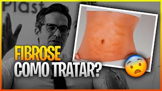 COMO TRATAR A FIBROSE APÓS LIPOASPIRAÇÃO 😨 [upl. by Nadeen925]