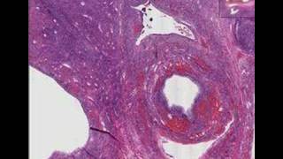 Histopathology Ovary Polycystic ovarian disease SteinLev [upl. by Ellebyam]