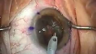 Modern Cataract Surgery Alcon ReSTOR IOL with LRI [upl. by Iatnwahs245]