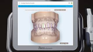 iTero™ scanner tutorial Invisalign® Outcome Simulator [upl. by Oznol]