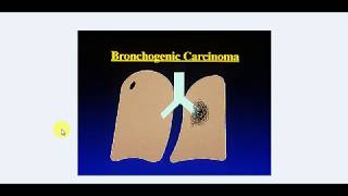 MEDICINE Lectures  Respiratory  TP 16  BRONCHOGENIC CARCINOMA [upl. by Brenan254]