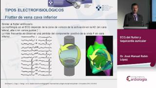 ECG del flutter y taquicardia auricular [upl. by Kalin]