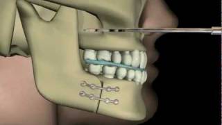 Çift Çene AmeliyatıUpper and Lower Jaw Surgery [upl. by Ihtac]