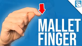 Cant Lift Your Fingertip   Mallet Finger  Part 1 [upl. by Anderson659]