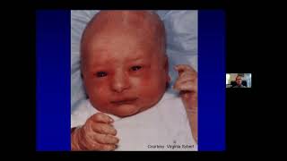 National Foundation for Ectodermal Dysplasias Webinar [upl. by Oralia205]