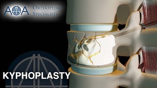 AOA Orthopedic Specialists  Kyphoplasty [upl. by Eatnhoj]