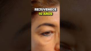 Blefaroplastia y Lifting de Cejas para eliminar párpados caidos y mirada cansada blefaroplastia [upl. by Yssirhc]