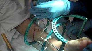 Removal of External Fixation [upl. by Aronid]