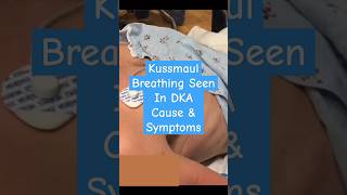 kussmaul breathing seen in dka mbbs [upl. by Aihseit463]