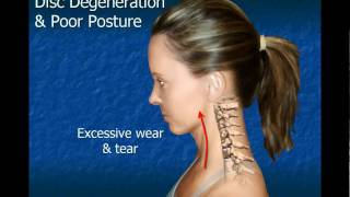 Cervical Disc Degeneration [upl. by Aketal]