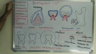 Dentigerous cyst [upl. by Ann]