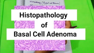 Histopathology of Basal cell Adenoma Monomorphic Adenoma [upl. by Flessel]