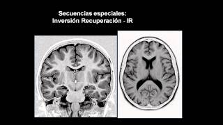 introducción a las neuroimágenes [upl. by Aihsoek469]