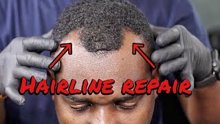 Full Hairline Restoration 4k [upl. by Doner880]