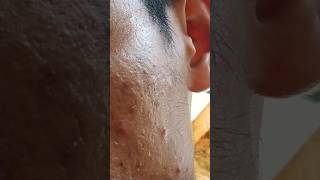 115 acne blackheads lyrics madskincare newmusic satisfying skincare song stitch [upl. by Othello]