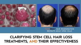 What You Need to Know About Stem Cell Hair Restoration and the Treatments that Work [upl. by Flodnar547]