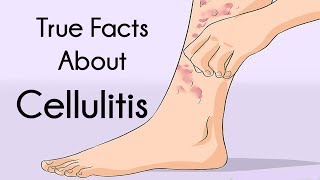 True Facts About Cellulitis [upl. by Eimar]