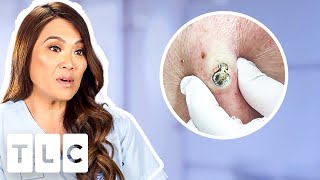 Top 5 Pimple Popping Moments From A 55YearOld Blackhead To Oozing Fistulas [upl. by Nessnaj]