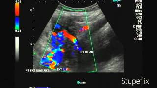 Color Doppler video of uterine artery in 2nd trimester [upl. by Anaujal]