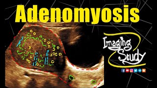 Adenomyosis  Uterus  Ultrasound  Case 330 [upl. by Ranzini]