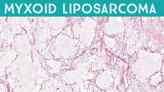 Myxoid liposarcoma high grade formerly round cell liposarcoma AIP France 2021 [upl. by Lyckman]