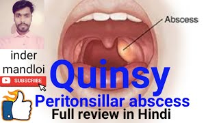 QuinsyPeritonsillar abscessDefinitioncausesclinical featuresdiagnosiscomplicationstreatment [upl. by Brenk]