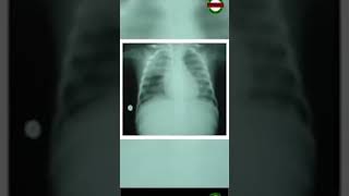 What Is Pulmonary Edema [upl. by Nyroc]