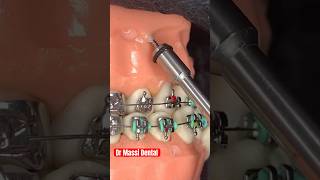 Class III Correction with Brackets A Comprehensive Orthodontic Procedure [upl. by Neyuq449]