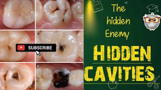 Pits and Fissure Caries Hidden carious lesions 🦷🤕 [upl. by Betthel587]